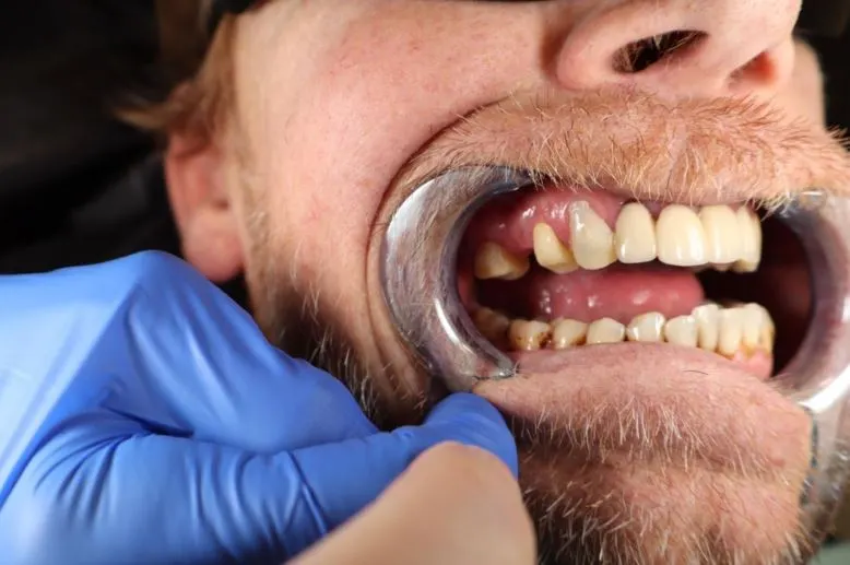missing tooth before bridge