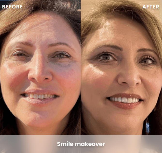 Smile Makeover