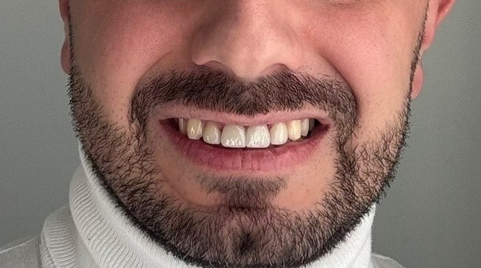 after smile makeover in ottawa