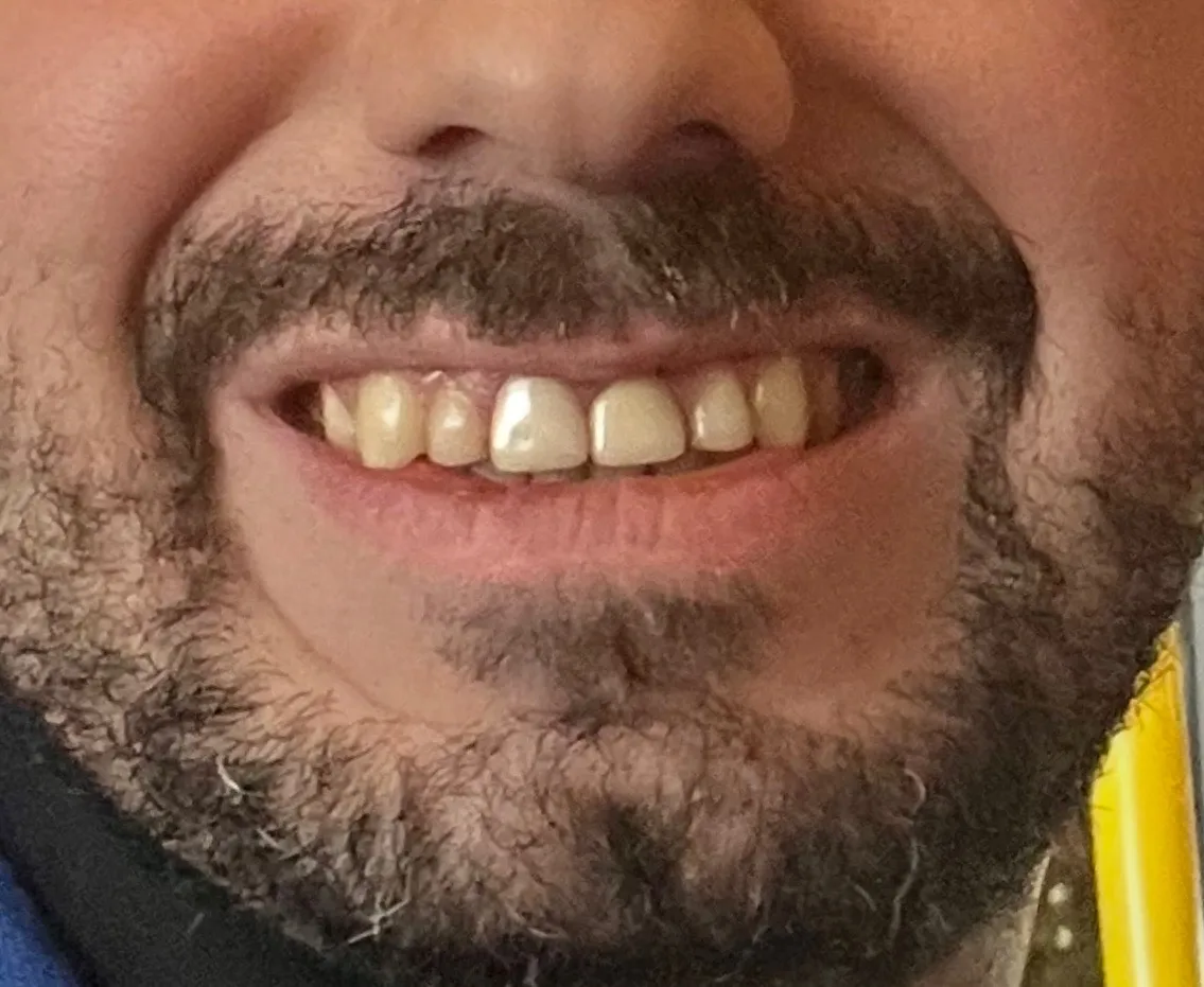 before smile makeover in Ottawa